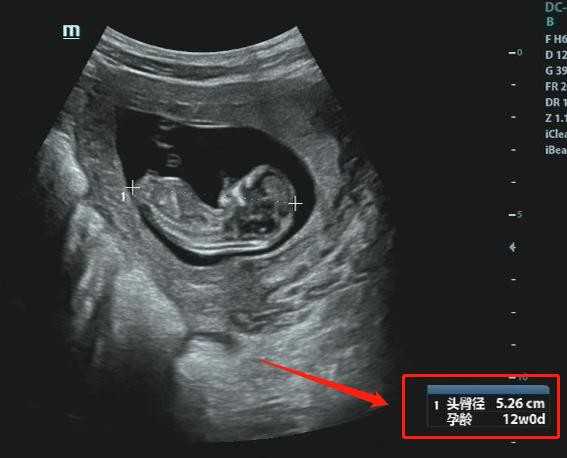 武汉专业的合法代孕-做供卵也不成功_怀孕三个月胎儿发育到什么程度(三个月胎